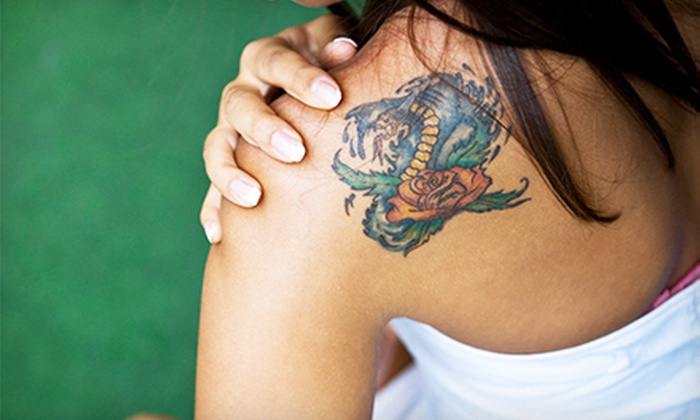 laser x tattoo removal reviews