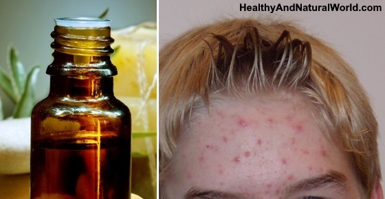tea tree oil and acne reviews