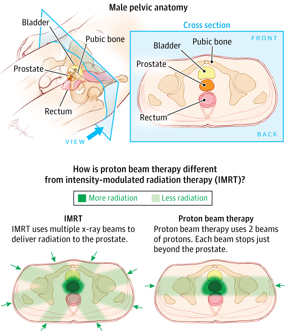 proton therapy for prostate cancer reviews
