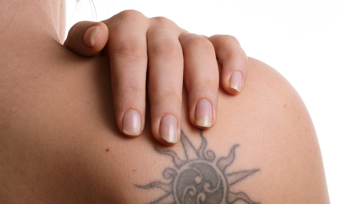laser x tattoo removal reviews